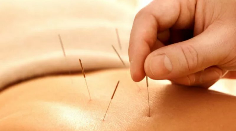 ACUPUNCTURE