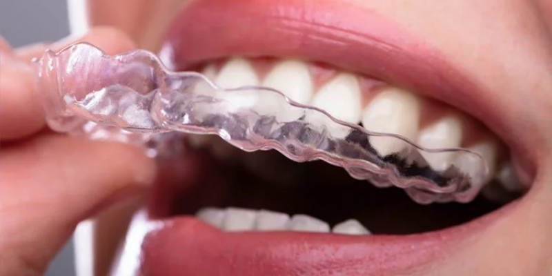 Invisalign